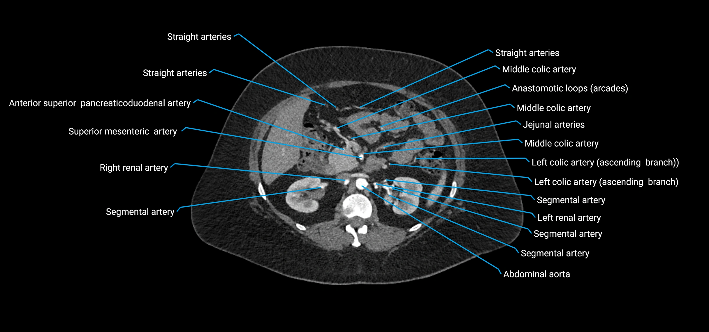 CTA abdomen axial cross sectional anatomy labelled image_71 (2).webp